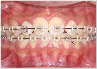 矯正歯科のイメージ