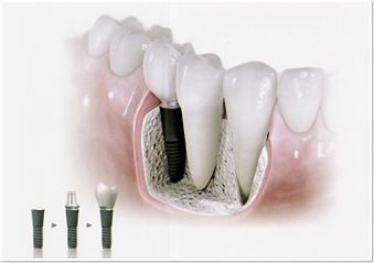 インプラントのイメージ